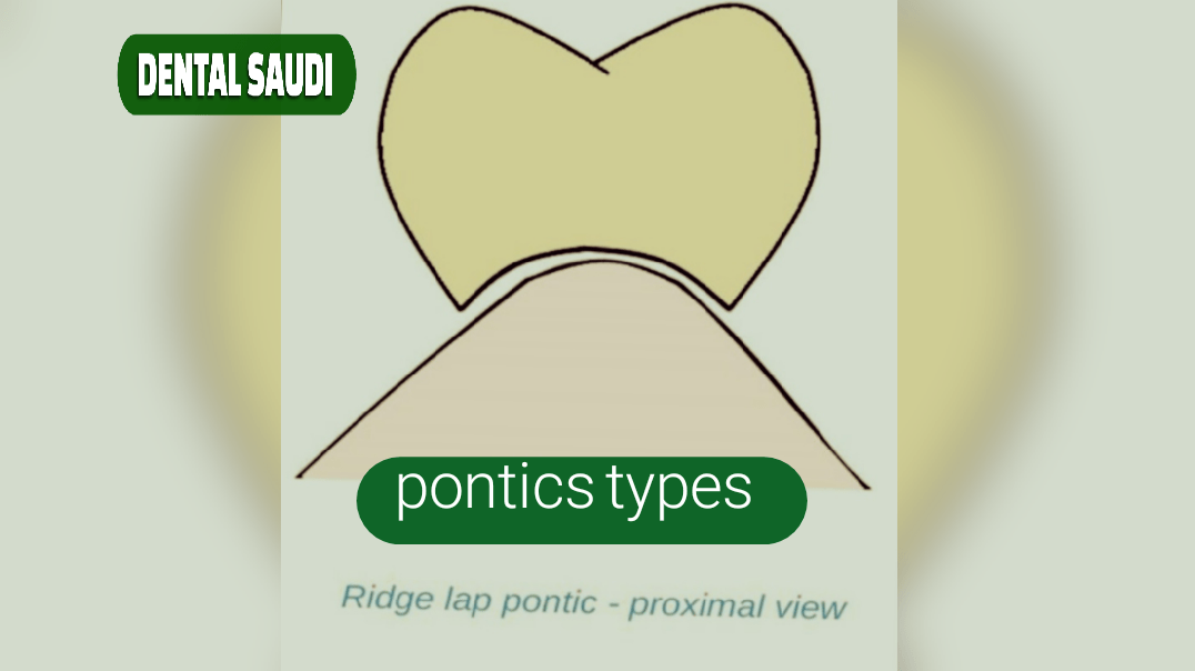 pontics dentistry