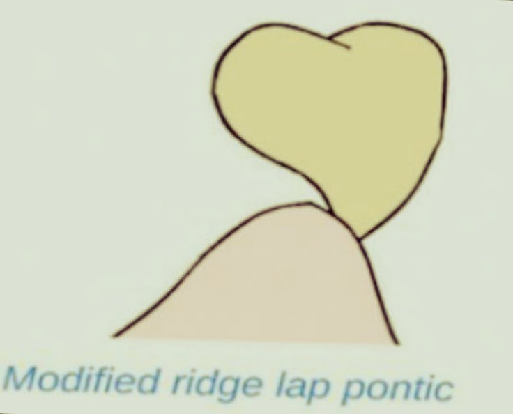 Modified ridge lap